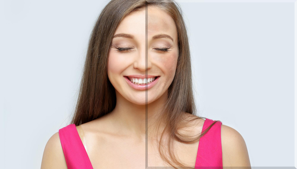 Melasma